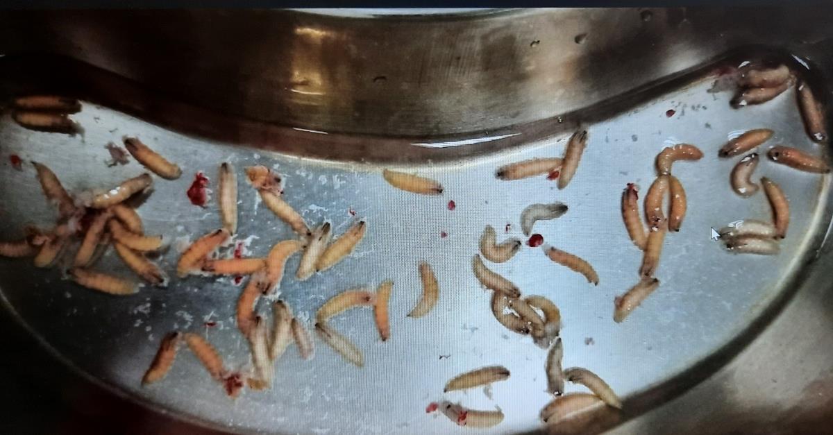 Hàng chục con dòi được gắp ra từ trong hốc mũi ông T.