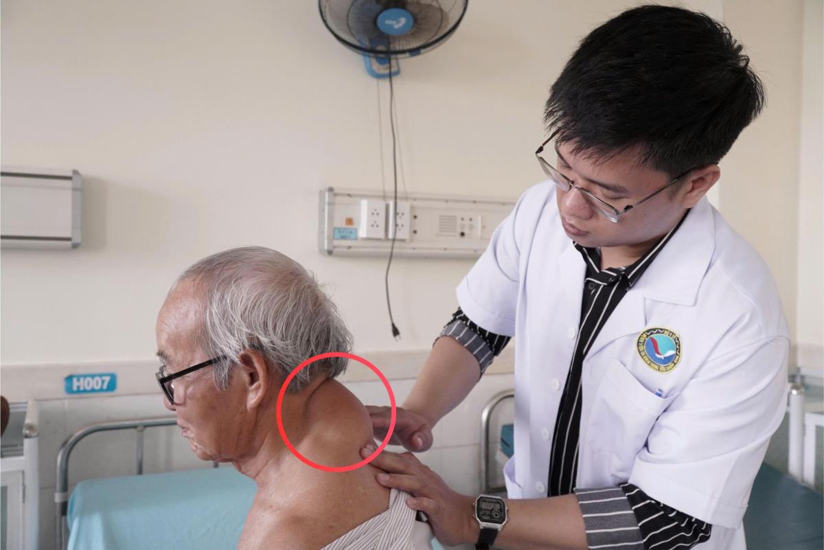 Khối u lớn vùng cổ gáy ông Nguyễn Tấn Phi trước phẫu thuật.