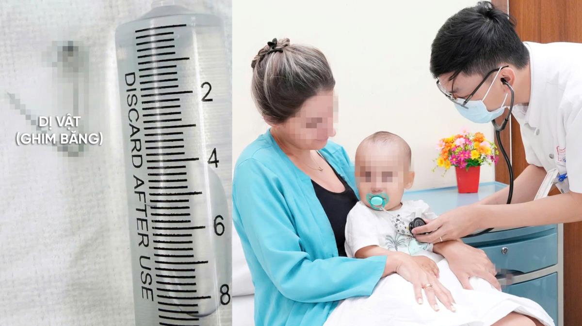 Dị vật được gắp ra từ thực quản của bệnh nhi.